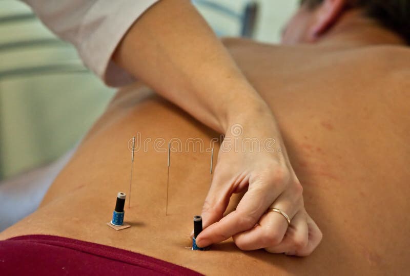 Acupunctura fotos de stock royalty free Acupunctura fotos de stock royalty free