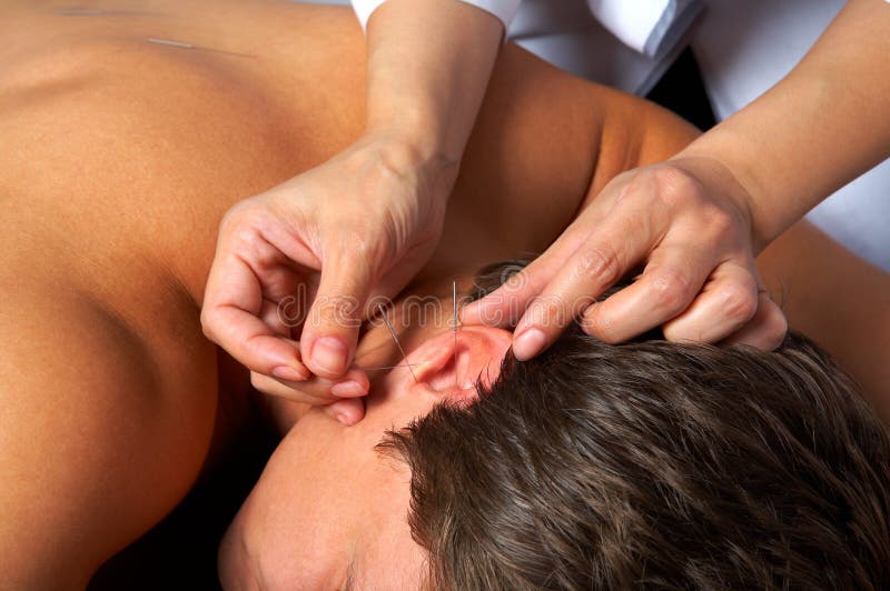 Acupunctura da orelha imagem de stock royalty free Acupunctura da orelha imagem de stock royalty free