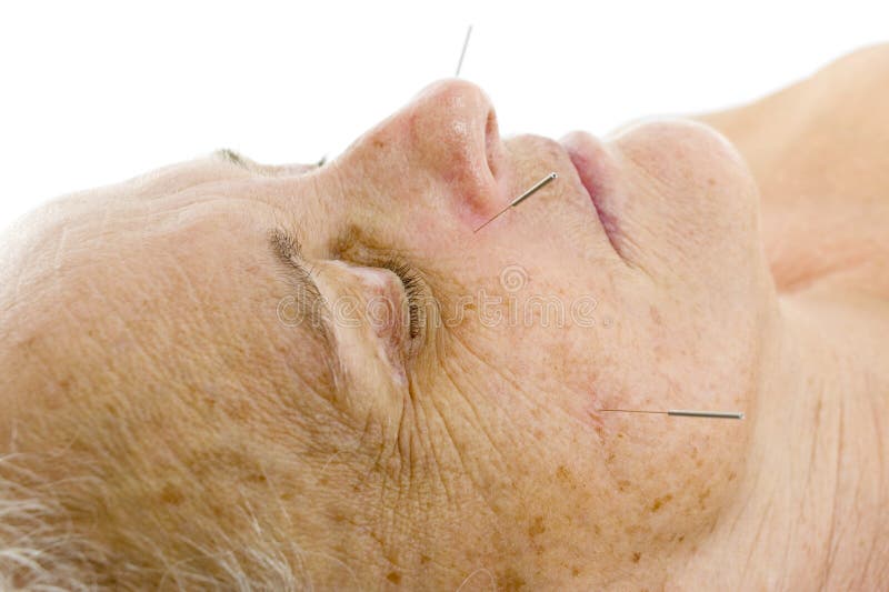 Acupuncture stock image. Image of wellness, care, master 12566081