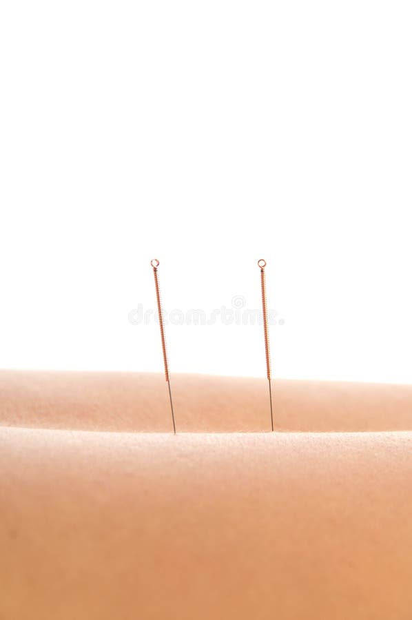 Acupuncture stock image. Image of herbal, healing, acus 30793153