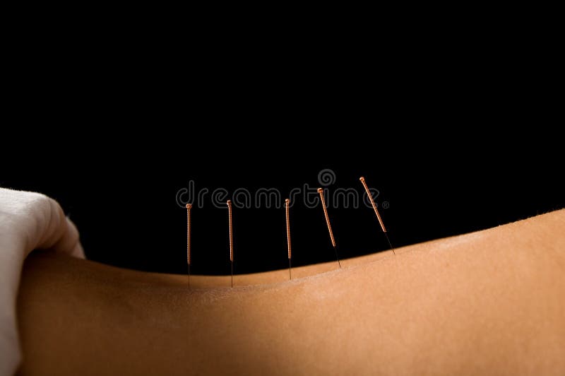 9,873 Acupuncture Photos Free & RoyaltyFree Stock Photos from Dreamstime