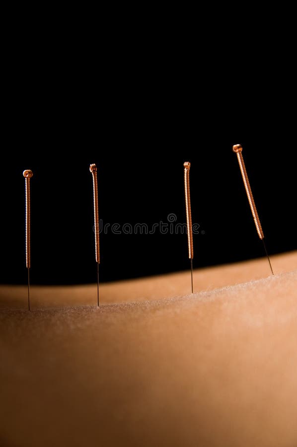 Acupuncture stock photo. Image of needle, natural, luxury 5182356
