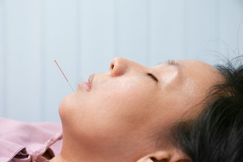 Acupuncture Stock Image Image 34861831