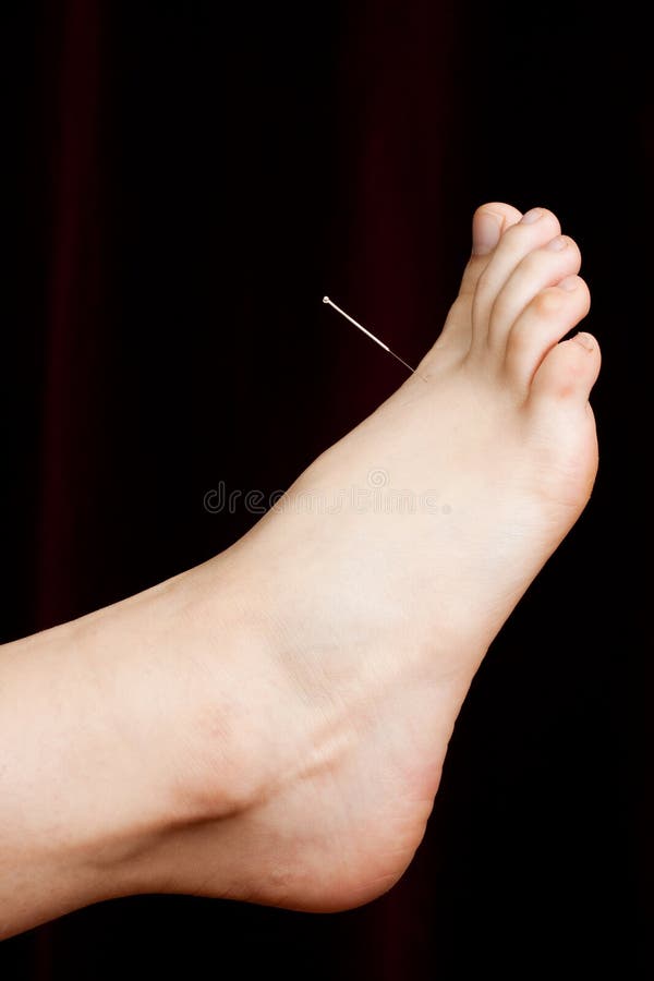 Acupuncture on a foot stock image. Image of body, medicine 11654203