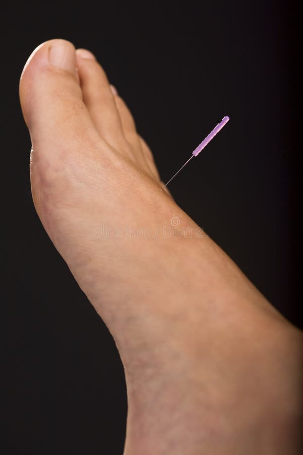 Acupuncture foot stock image. Image of foot, acupuncture 7313229