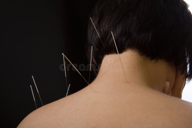 Acupuncture Needle stock photo. Image of chinese, filiform 13474798