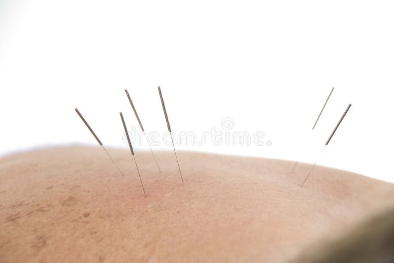 Acupuncture Needles in Backs Stock Photo Image of massage, column