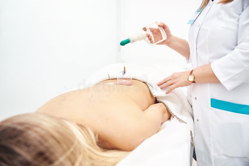 Acupuncture therapist woman placing a cup on the back of a woman patient for cupping massage. medical and health concept stock photo Acupuncture therapist woman placing a cup on the back of a woman patient for cupping massage. medical and health concept stock photo
