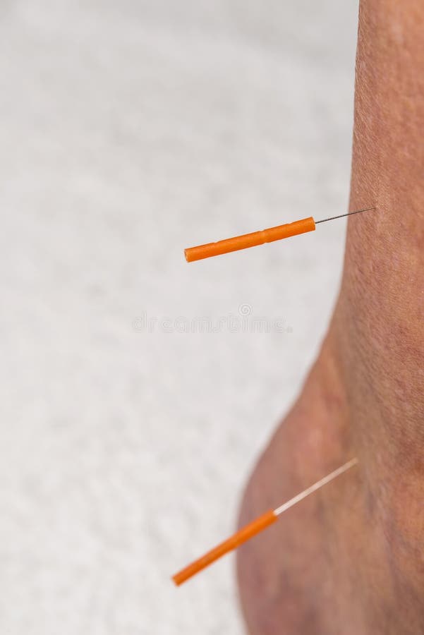 Acupuncture Treatment on Leg Stock Photo Image of soft, traditional