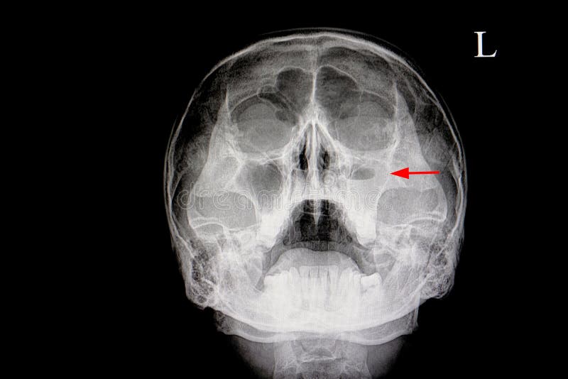 Sinus X-Ray: Why Is Performed and Results