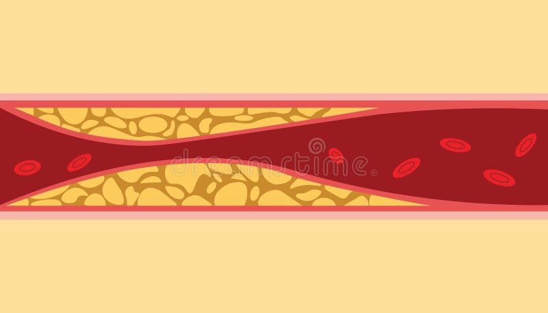 Aderzellstromfluß des menschlichen Bluts Cholesterins UNO gesunder mit Fett auf Seite mit flacher Artillustration vektor abbildung Aderzellstromfluß des menschlichen Bluts Cholesterins UNO gesunder mit Fett auf Seite mit flacher Artillustration vektor abbildung