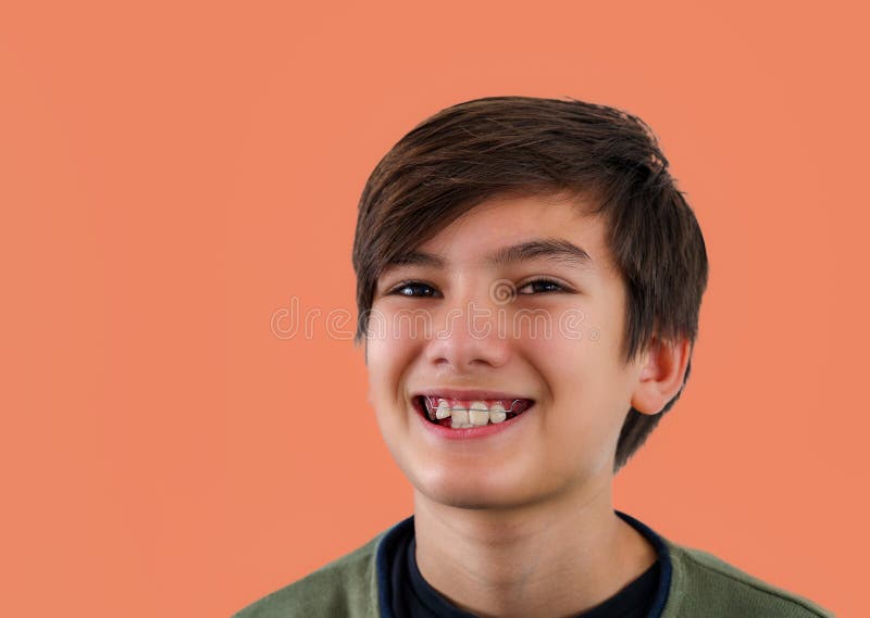 Adolescent avec des dents de la diastéa overbite absence d'espace habillé traitement de l'appareil orthodontique. bracelets dentai photo libre de droits