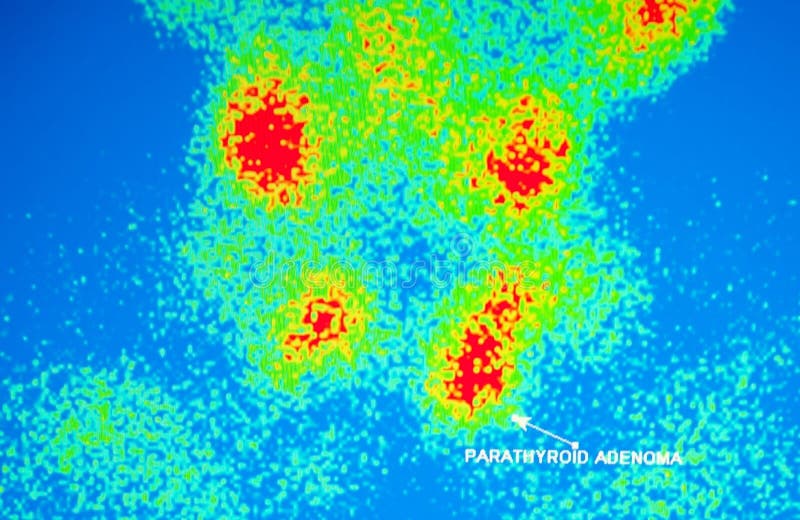 Parathyroid nuclear scan ,impressive diagnostic imaging of adenoma in one of the lobe , this is result of isotope Tc sestamibi ,which is specific for this type of test. Parathyroid nuclear scan ,impressive diagnostic imaging of adenoma in one of the lobe , this is result of isotope Tc sestamibi ,which is specific for this type of test