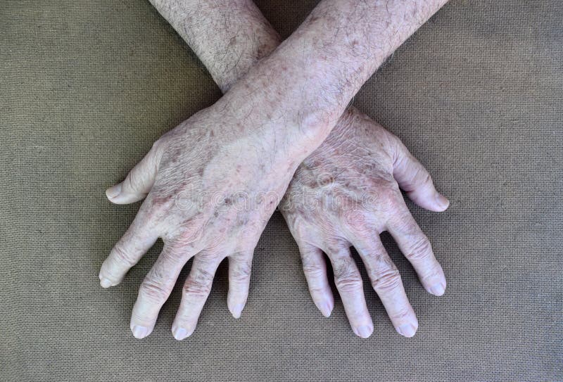 184 Age Spots Hands Photos Free Royalty Free Stock Photos From Dreamstime 184 Age Spots Hands Photos Free Royalty Free Stock Photos From Dreamstime