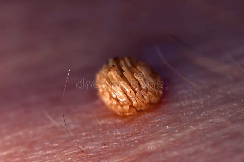 pics Arm Pictures Of Warts 103 age wart photos free royalty