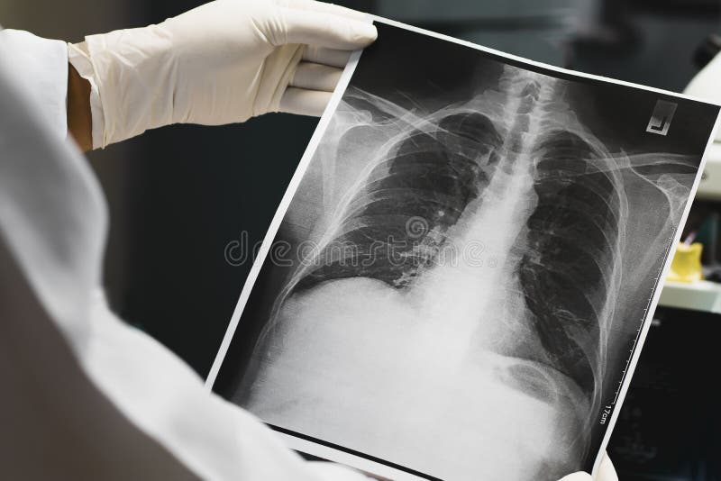 Aggiusti l'esame della radiografia del polmone, medico che guarda la lastra radioscopica del petto fotografia stock libera da diritti Aggiusti l'esame della radiografia del polmone, medico che guarda la lastra radioscopica del petto fotografia stock libera da diritti