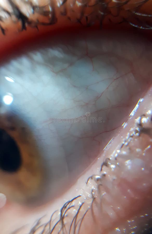 The Aggravation after Working at the Computer. Red Eye Conjunctivitis