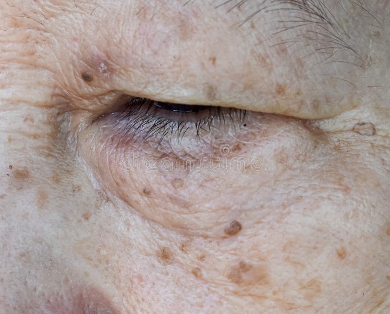 Aging skin folds or skin creases or wrinkles and aging spots at face especially around eye of Southeast Asian, Chinese elderly