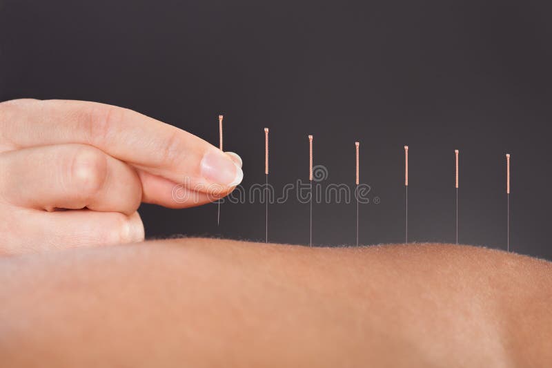 Akupunkturbehandling royaltyfria bilder Akupunkturbehandling royaltyfria bilder