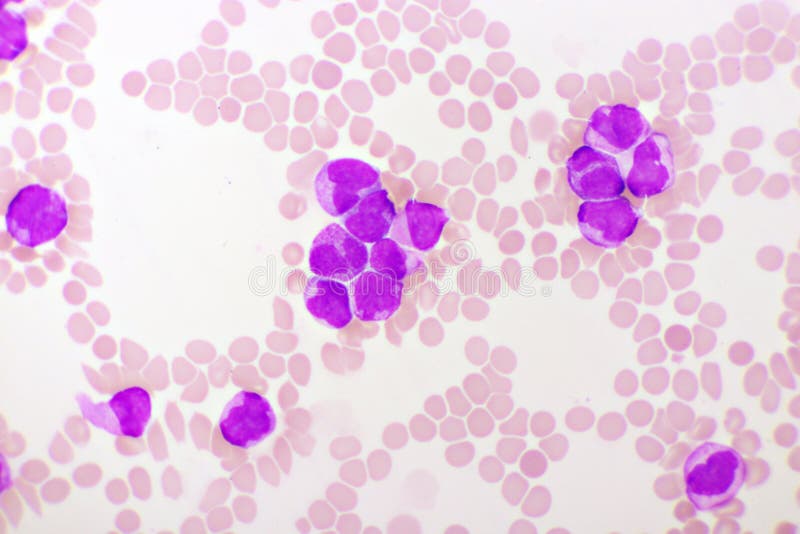 Akuta promyelocytisk leukemiceller eller apl. Akut promyelocytisk leukemi- celler eller apl- analys med mikroskop ursprunglig förstoring 1000 x