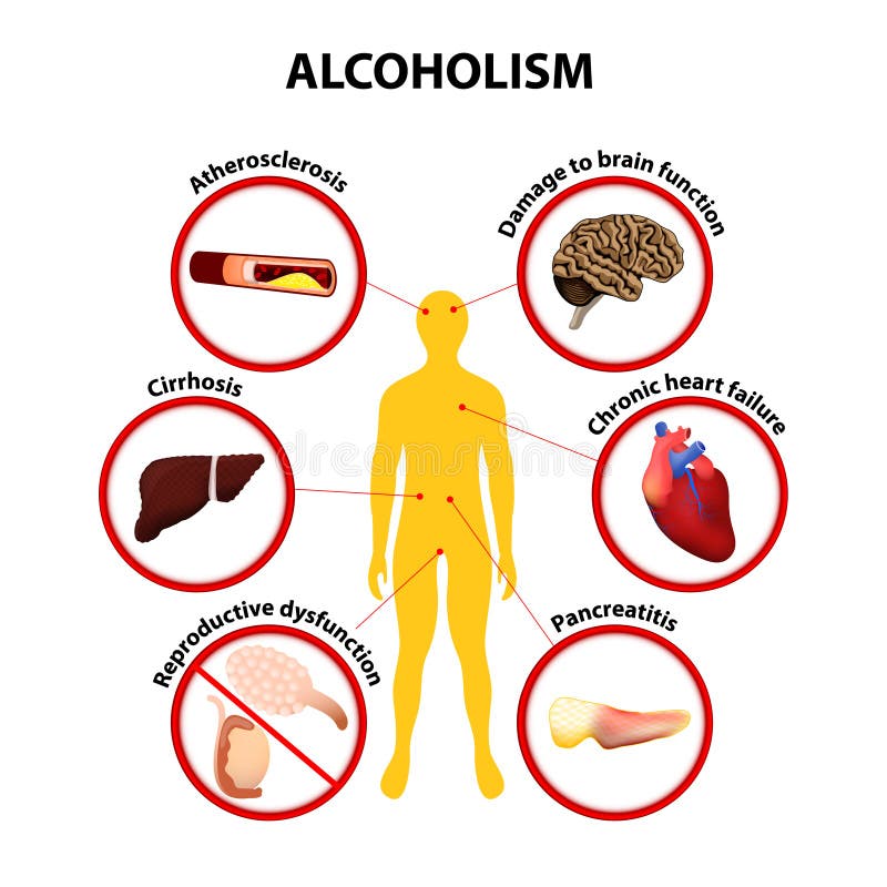 alcolismo Infographic