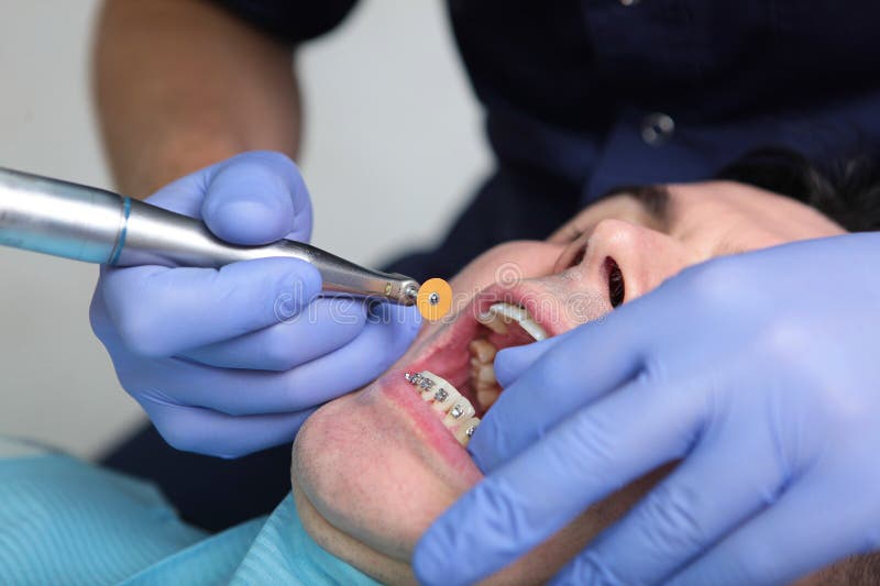 Alignment of the Dentition with Braces. Separation of the Dentition