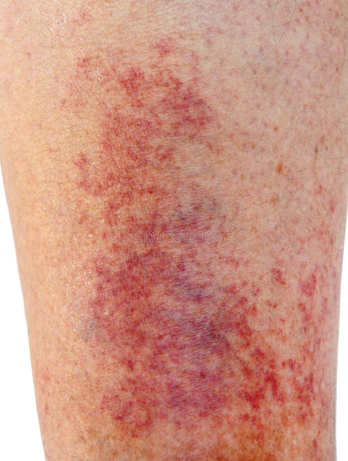 Allergic Rash Dermatitis Skin Stock Photos Download 2,230 Royalty