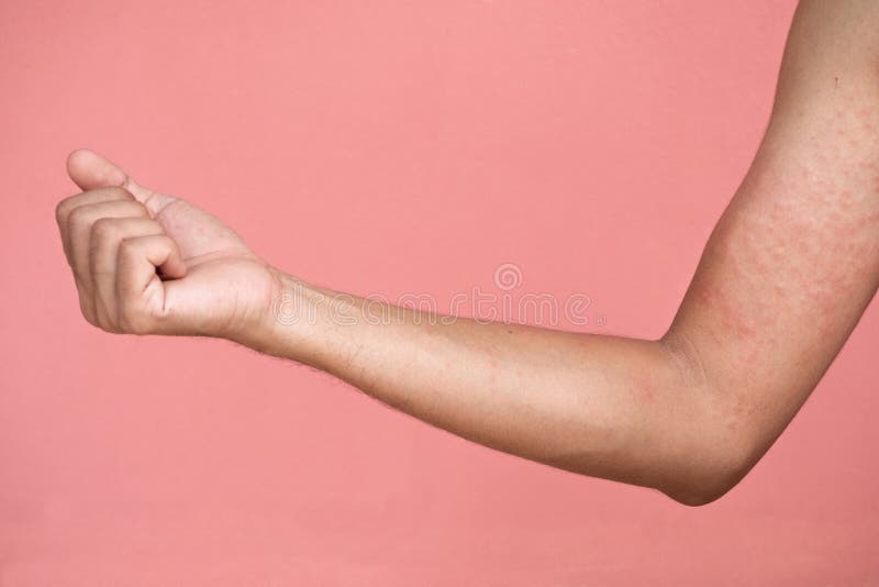 Allergic Rash On Right Arm Stock Image Image Of Healthy 126947259