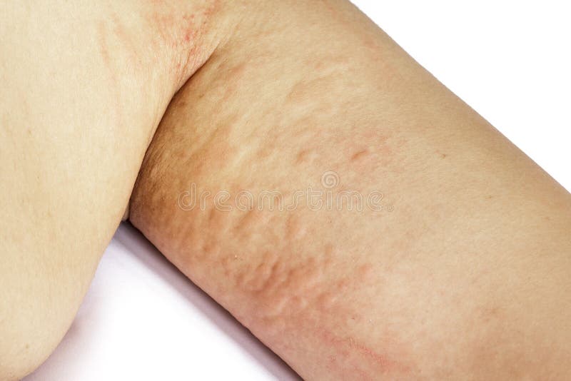 Allergic Rash Dermatitis Skin Stock Image Image of dermatitis