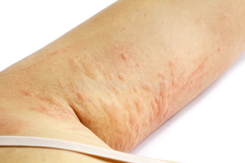 Allergic Rash Skin of Patient Arm Stock Photo - Image of allergy ...