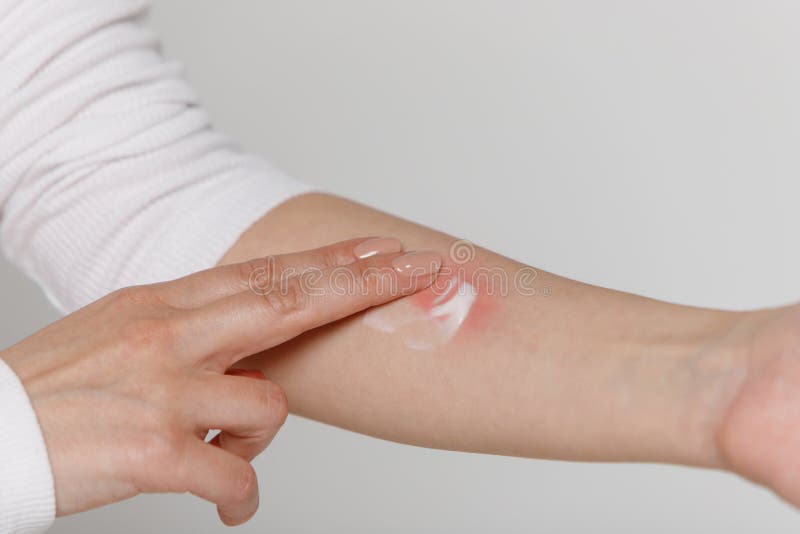 Woman is applying cream/ointment on the swell skin against mosquito bites