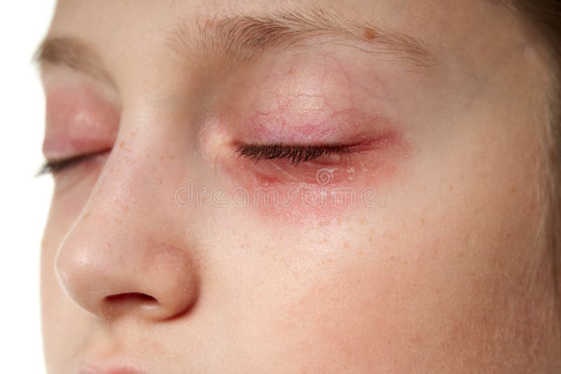Reacción alérgica en la cara que hacer