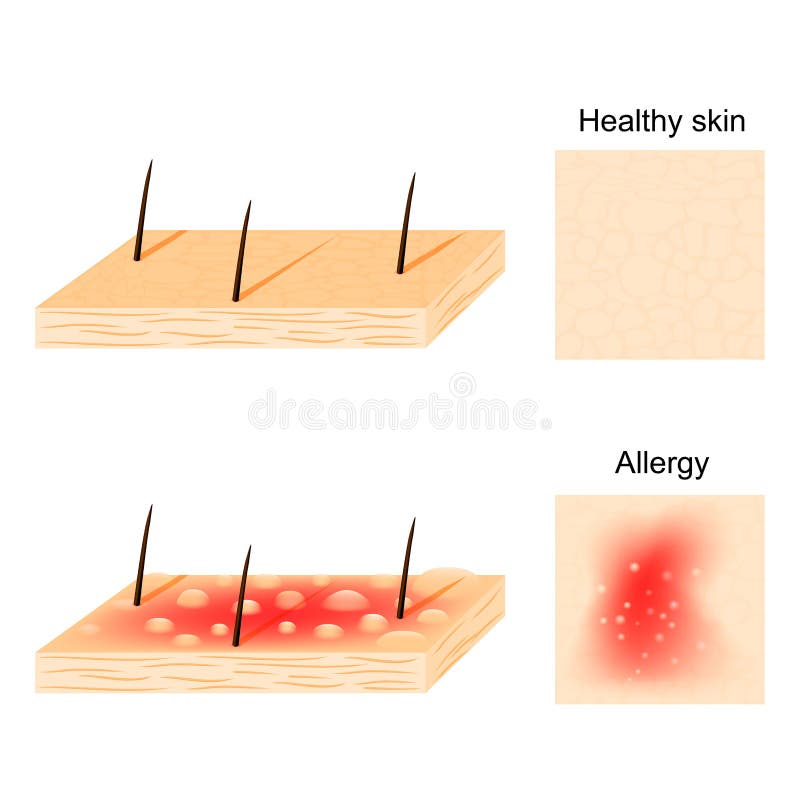 allergie peau saine et réactions allergiques illustration de vecteur allergie peau saine et réactions allergiques illustration de vecteur