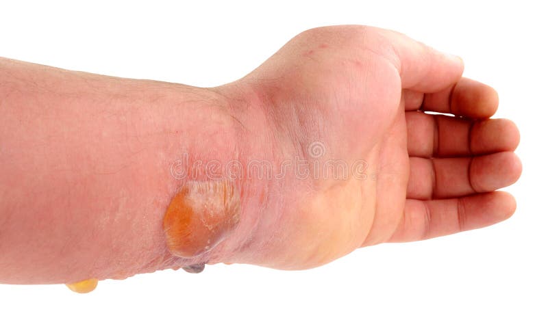 Allergische reactie op insectenbeet royalty-vrije stock foto's