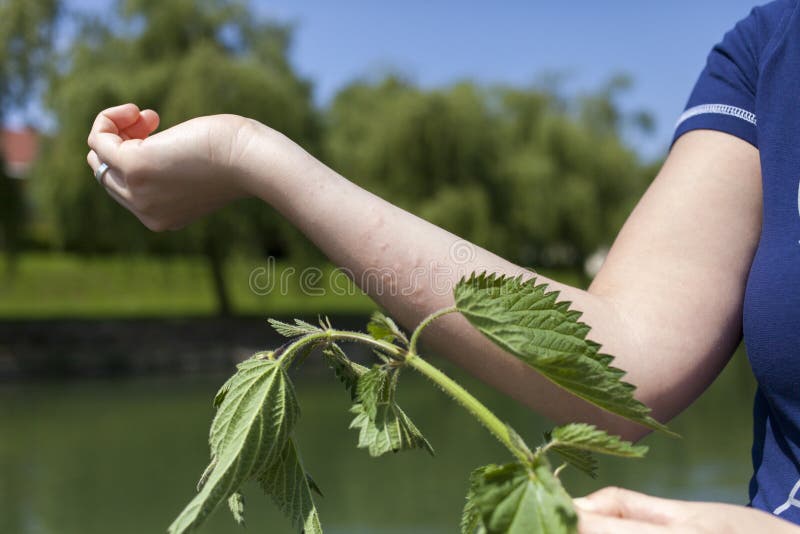 Allergische Reaktion der stechenden Nessel lizenzfreie stockfotografie Allergische Reaktion der stechenden Nessel lizenzfreie stockfotografie