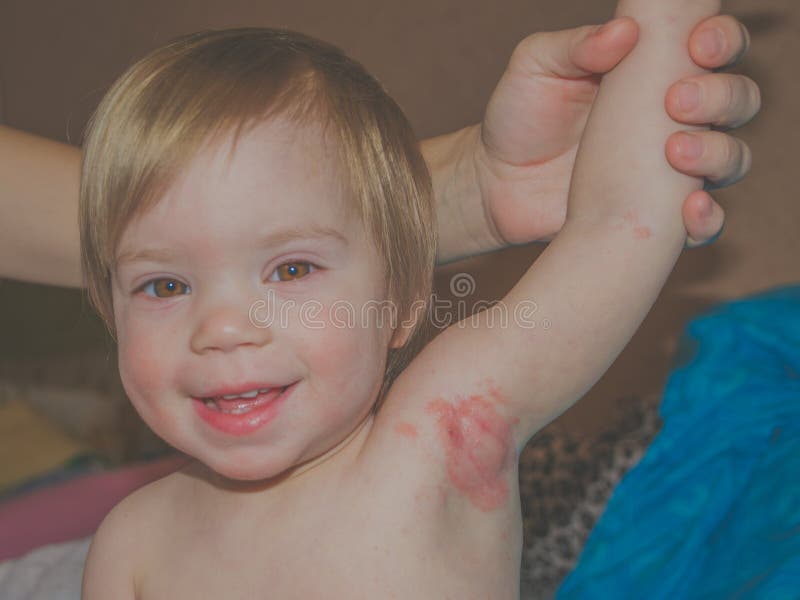 Allergy in Children in the Axilla Stock Image - Image of dermatology,  eczema: 103537727