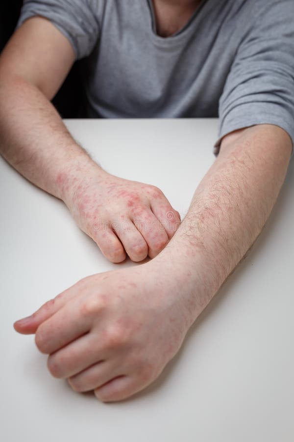 Allergy Red Itchy Rash On Male Hands And Arms On White Table