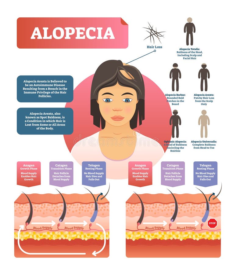 Alopeci - illustration för diagram för vektor för autoimmune sjukdom för hårförlust medicinsk royaltyfri illustrationer Alopeci - illustration för diagram för vektor för autoimmune sjukdom för hårförlust medicinsk royaltyfri illustrationer