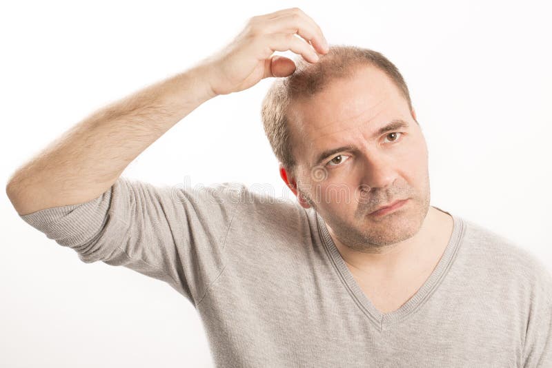 Alopecia φαλάκρας απώλεια τρίχας ατόμων haircare στοκ εικόνα με δικαίωμα ελεύθερης χρήσης Alopecia φαλάκρας απώλεια τρίχας ατόμων haircare στοκ εικόνα με δικαίωμα ελεύθερης χρήσης