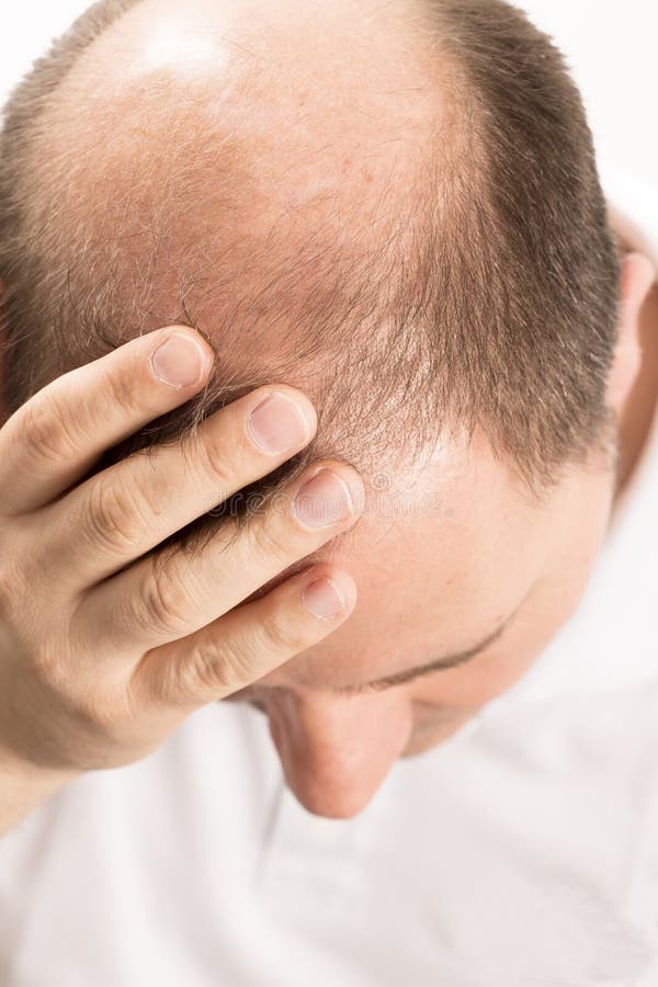 Alopecia φαλάκρας απώλεια τρίχας ατόμων haircare στοκ φωτογραφία με δικαίωμα ελεύθερης χρήσης Alopecia φαλάκρας απώλεια τρίχας ατόμων haircare στοκ φωτογραφία με δικαίωμα ελεύθερης χρήσης