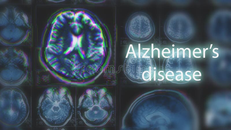 Alzheimer ` s choroba lub Parkinson pojęcie Zamazany MRI obraz cyfrowy mózg z usterka skutkiem