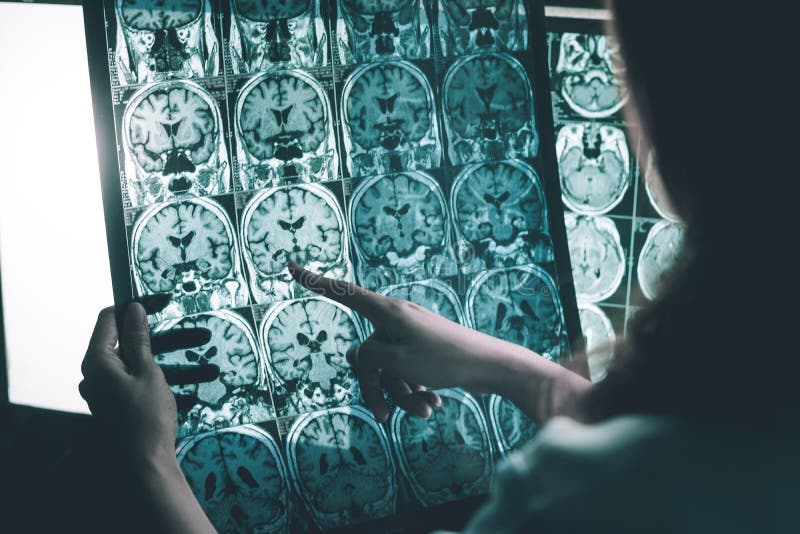 Alzheimer ` s choroba na MRI