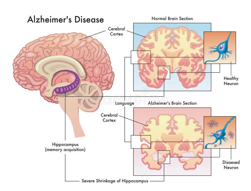 Alzheimer's Disease Diagram Stock Illustrations – 19 Alzheimer's ...