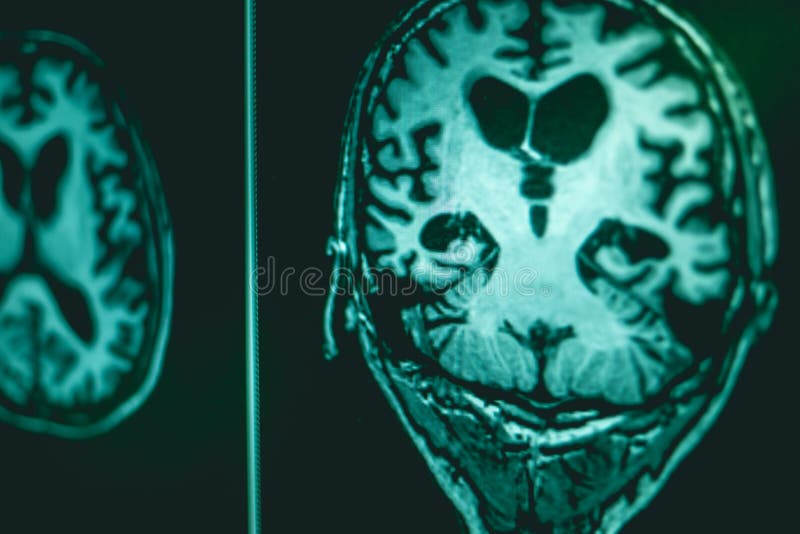 MRI Brian Of Dementia Patient Stock Image - Image of lobe, education