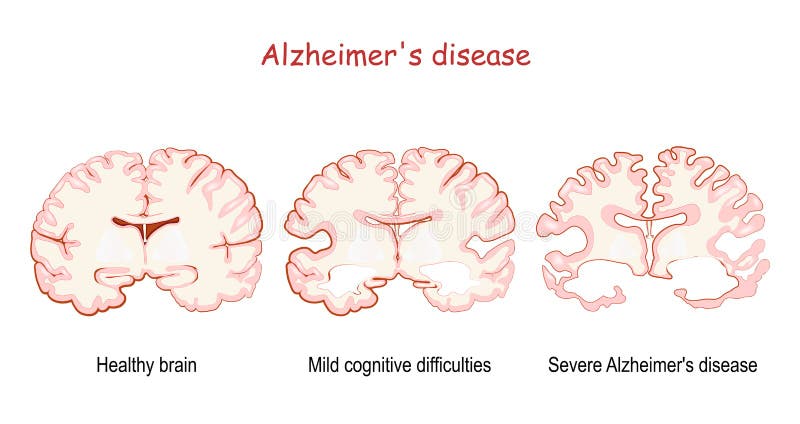 Alzheimer`s, is a neurodegenerative disease. dementia. Comparison and difference between Healthy brain, Severe Alzheimer`s disease, and Mild cognitive