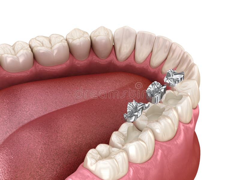 Amalgam Restoration. Medically Accurate 3D Animation of Dental Concept