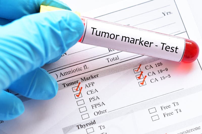 Amostra de sangue para o teste do marcador do tumor foto de stock royalty free Amostra de sangue para o teste do marcador do tumor foto de stock royalty free