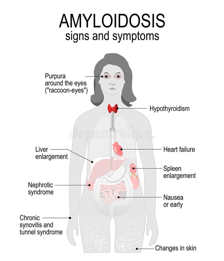 Amyloidosis is a disease by accumulation of proteins amyloid fibrils. Signs and symptoms. woman silhouette with highlighted internal organs. Amyloidosis is a disease by accumulation of proteins amyloid fibrils. Signs and symptoms. woman silhouette with highlighted internal organs.