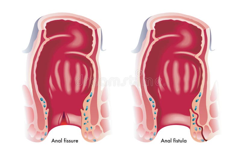 Anal Fissure Stock Illustrations – 90 Anal Fissure Stock Illustrations, Vectors & Clipart - Dreamstime Anal Fissure Stock Illustrations – 90 Anal Fissure Stock Illustrations, Vectors & Clipart - Dreamstime