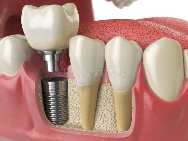 Anatomia dos dentes saudáveis e do implante dental do dente no dentu humano